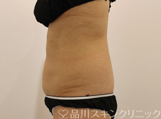 症例NO.65574のAFTER写真