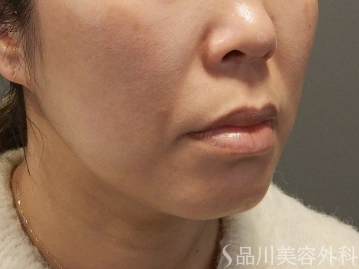 症例NO.69598のBEFORE写真