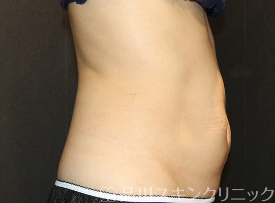 症例NO.71395のBEFORE写真
