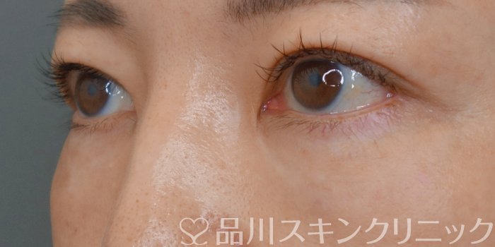 症例NO.72417のAFTER写真