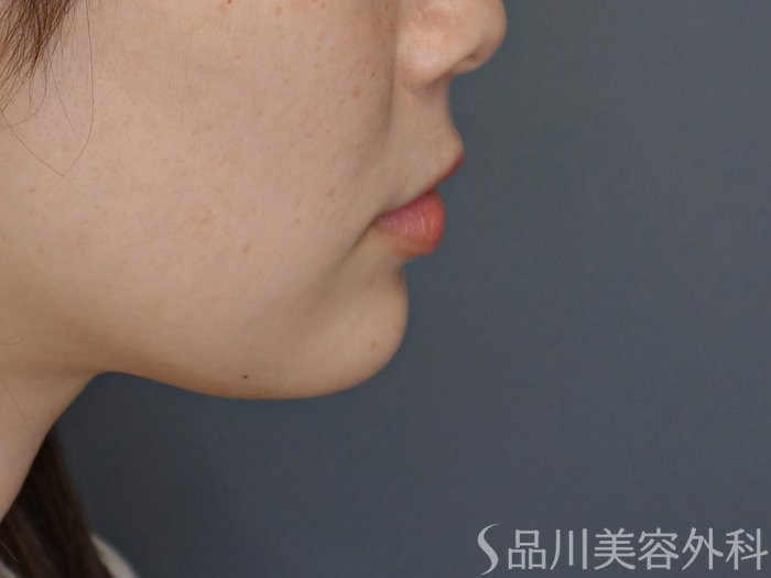 症例NO.72480のBEFORE写真