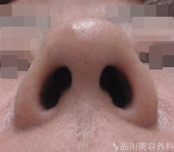 症例NO.22952のBEFORE写真