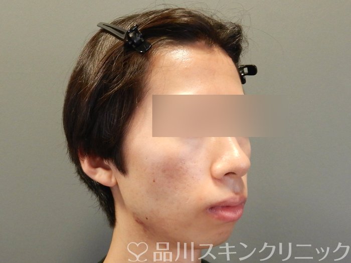 症例NO.65380のAFTER写真