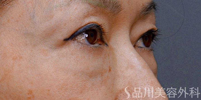 症例NO.74248のBEFORE写真