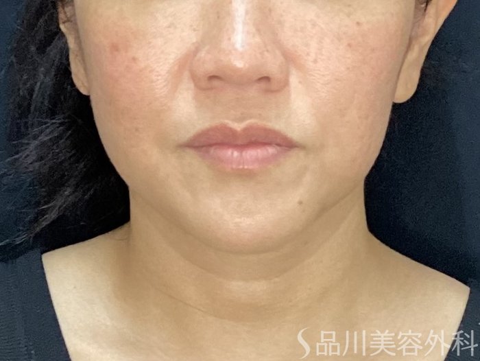 症例NO.71750のBEFORE写真