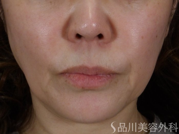 症例NO.71095のBEFORE写真