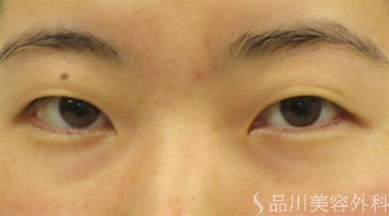 症例NO.47753のBEFORE写真