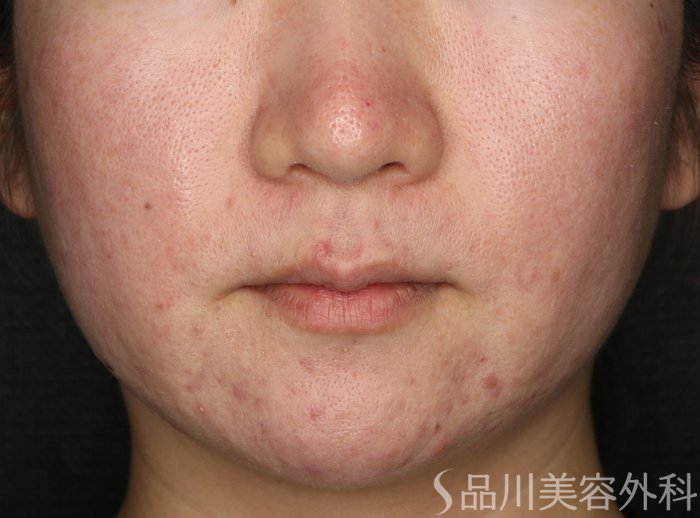 症例NO.72204のBEFORE写真