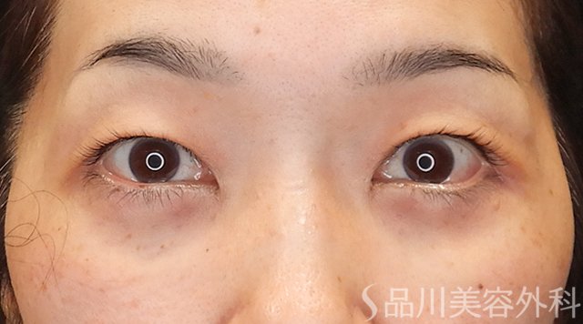 症例NO.75014のAFTER写真