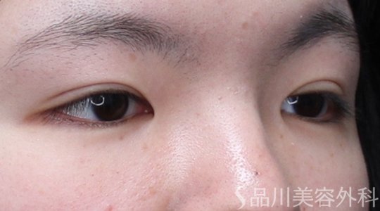 症例NO.73559のAFTER写真