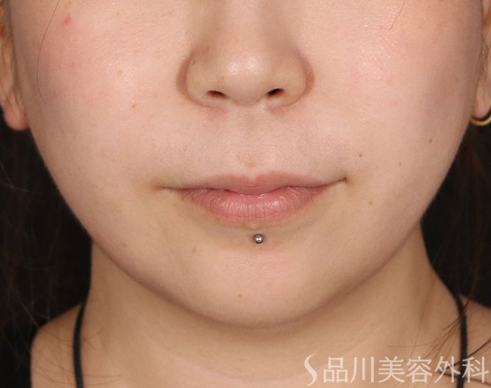 症例NO.71139のAFTER写真