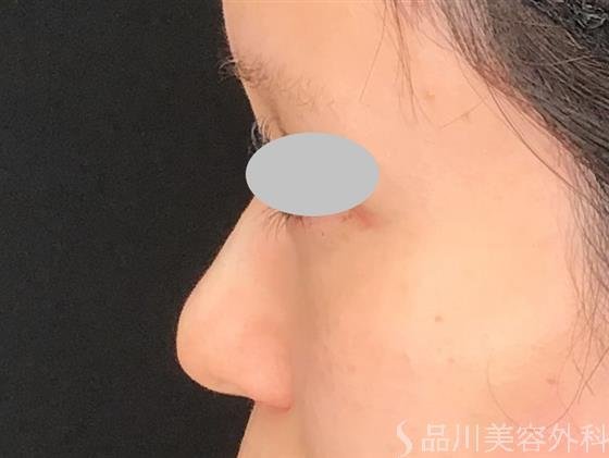 症例NO.61219のAFTER写真