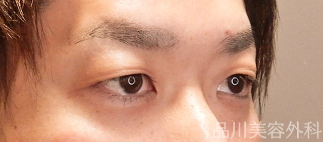 症例NO.70985のBEFORE写真