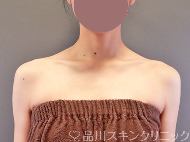 症例NO.64146のAFTER写真