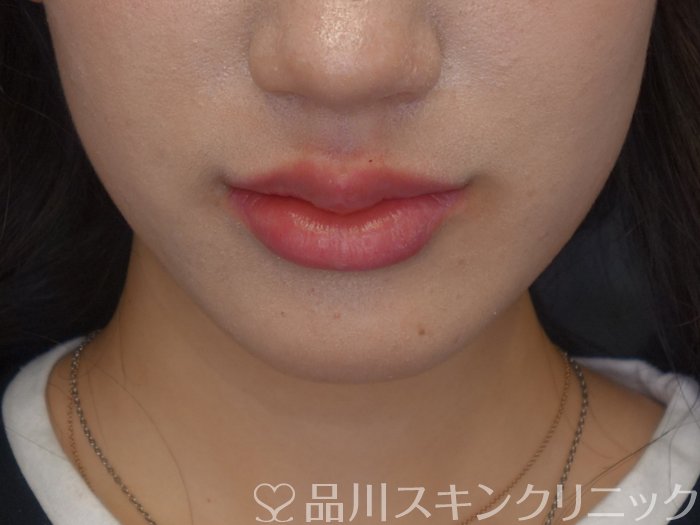 症例NO.74477のAFTER写真