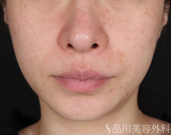 症例NO.71734のBEFORE写真