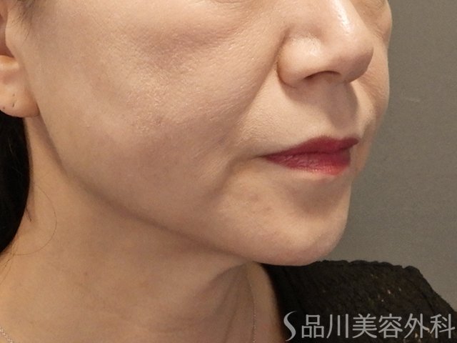 症例NO.72211のAFTER写真