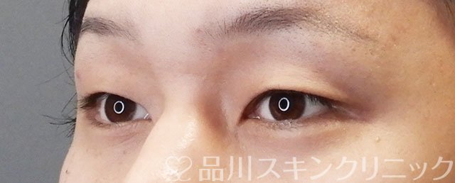 症例NO.73025のBEFORE写真