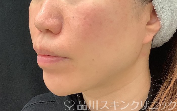 症例NO.69065のAFTER写真