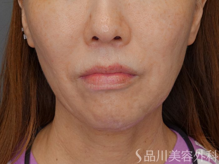症例NO.71890のBEFORE写真