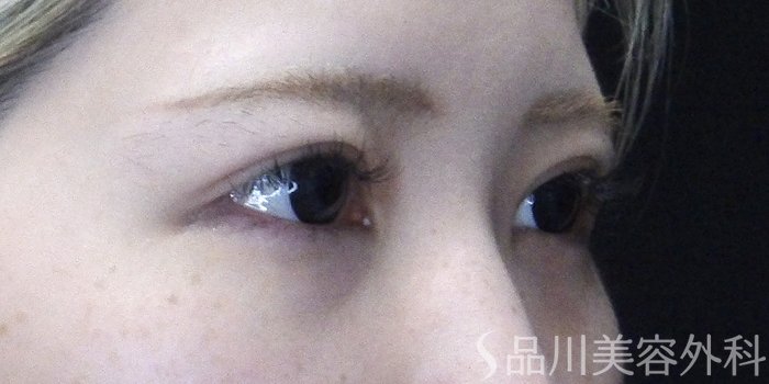 症例NO.70478のAFTER写真