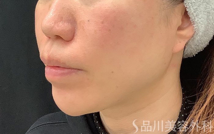 症例NO.69065のAFTER写真