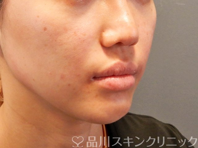 症例NO.70029のAFTER写真