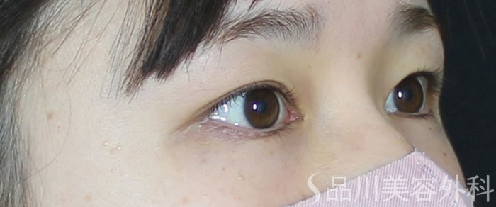 症例NO.69581のBEFORE写真