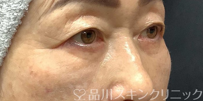 症例NO.69668のAFTER写真