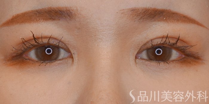 症例NO.72531のAFTER写真