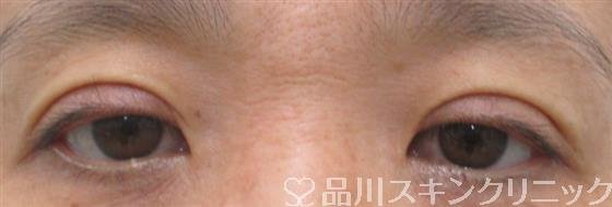 症例NO.26210のAFTER写真