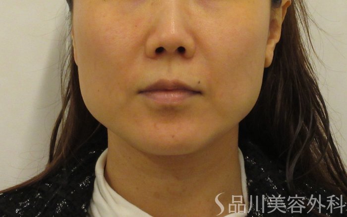 症例NO.73546のBEFORE写真