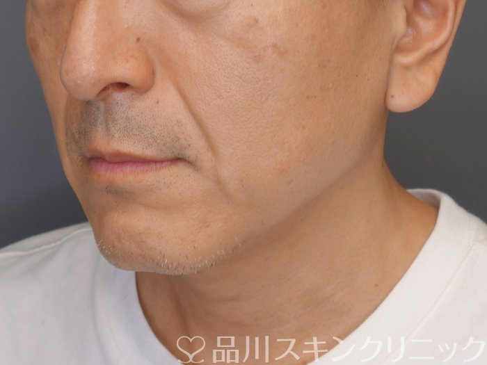 症例NO.71089のBEFORE写真