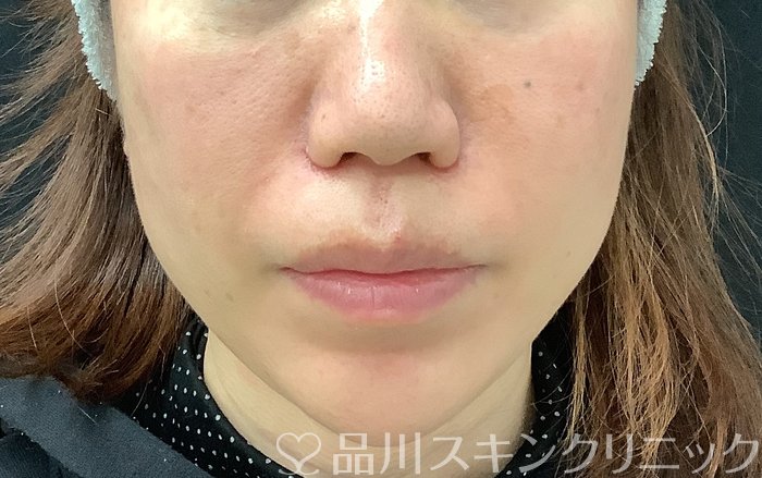 症例NO.69065のAFTER写真