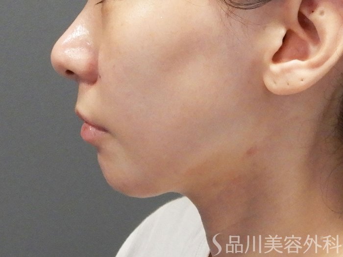 症例NO.74341のAFTER写真