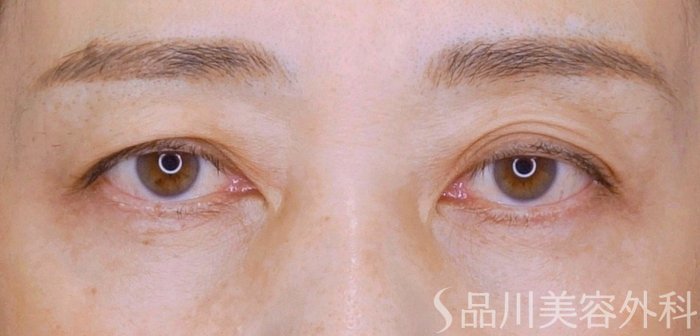 症例NO.74891のBEFORE写真