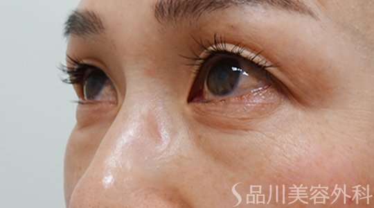 症例NO.70888のBEFORE写真