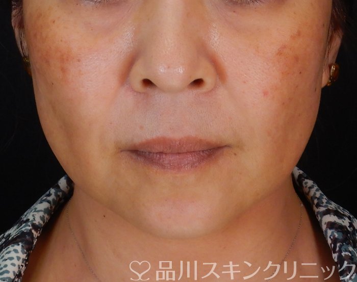 症例NO.66743のBEFORE写真