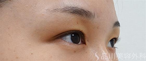 症例NO.53383のBEFORE写真