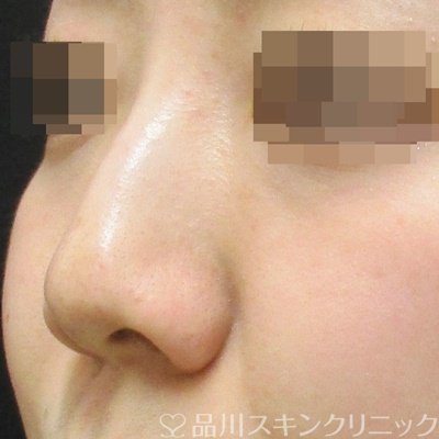 症例NO.70035のBEFORE写真