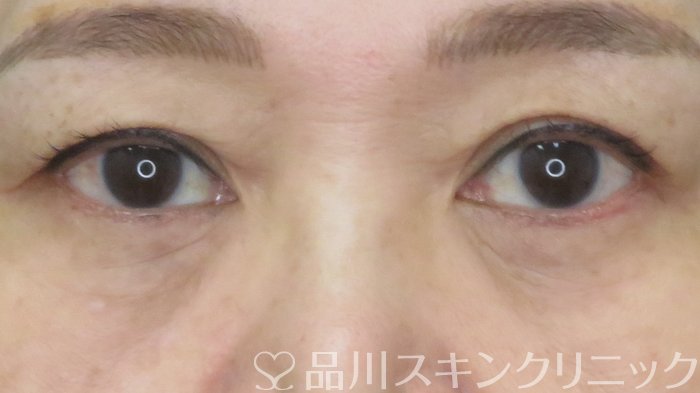 症例NO.71820のBEFORE写真