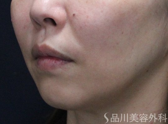 症例NO.74623のAFTER写真