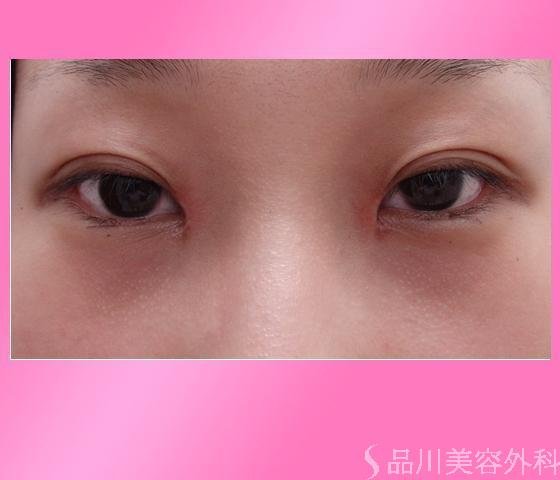 症例NO.7134のAFTER写真