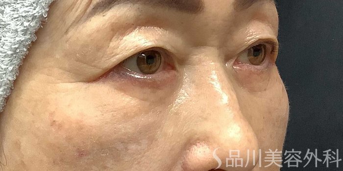 症例NO.69668のAFTER写真