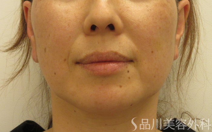 症例NO.70056のBEFORE写真