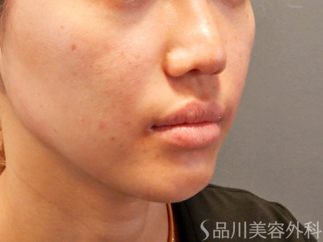症例NO.70029のAFTER写真
