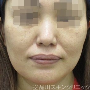 症例NO.65105のBEFORE写真