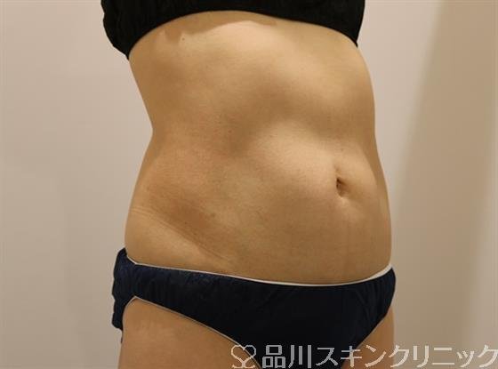 症例NO.43180のAFTER写真