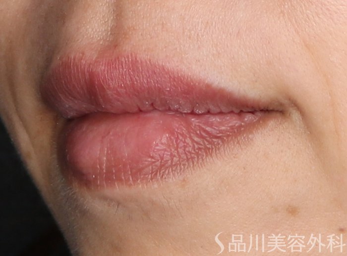 症例NO.70861のAFTER写真