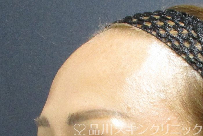 症例NO.70124のBEFORE写真